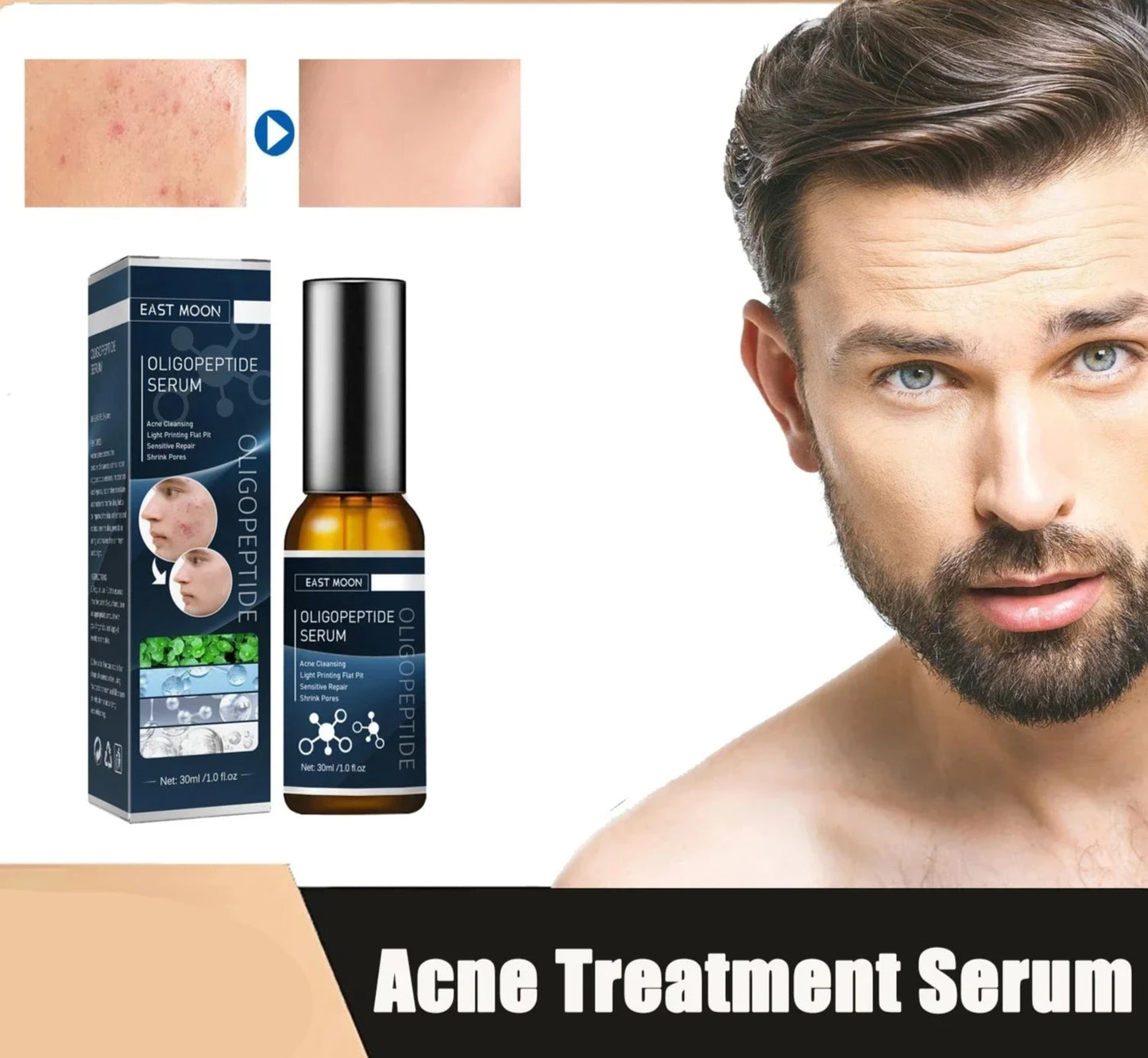 Men Acne Removal Serum