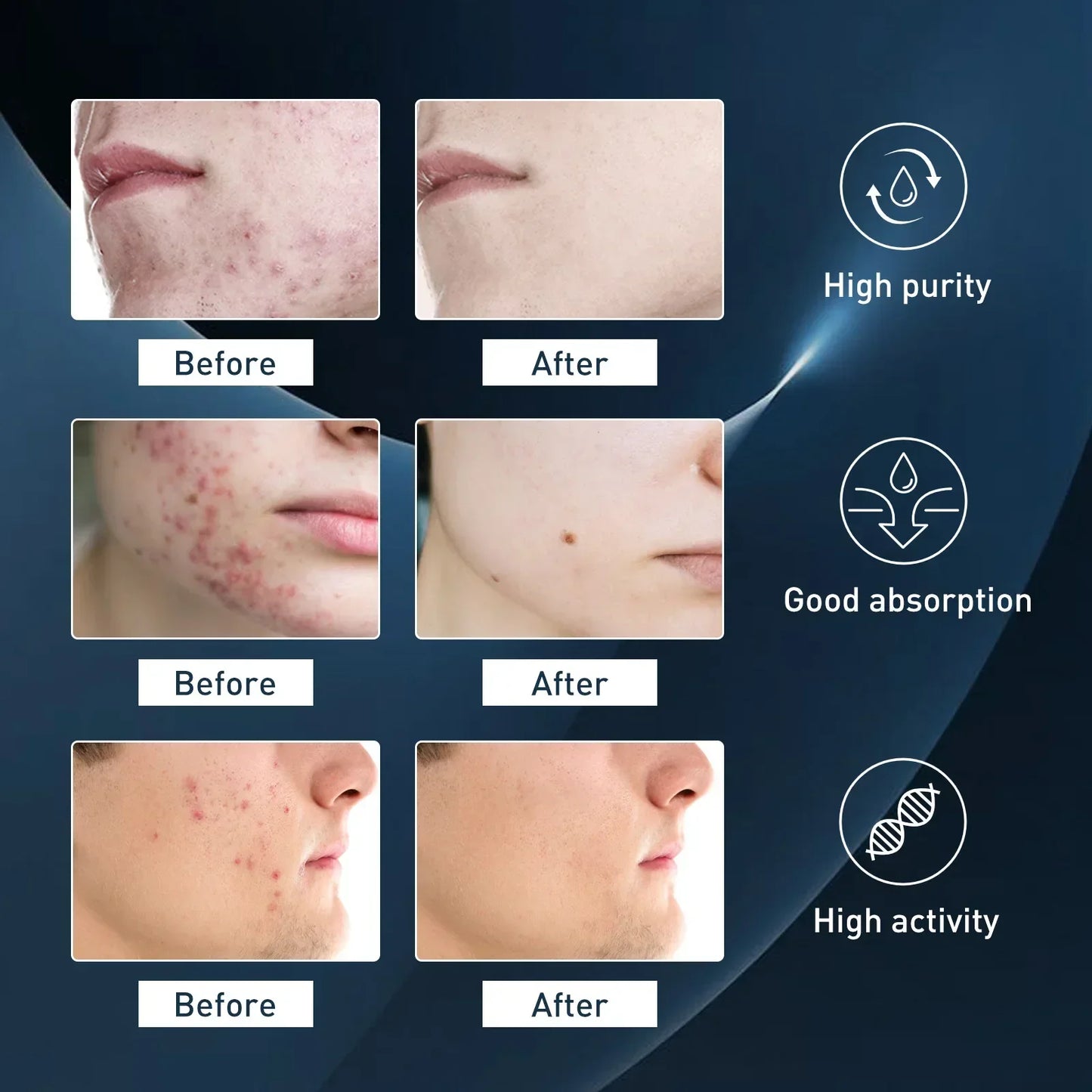 Men Acne Removal Serum