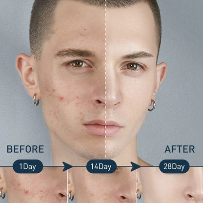 Men Acne Removal Serum